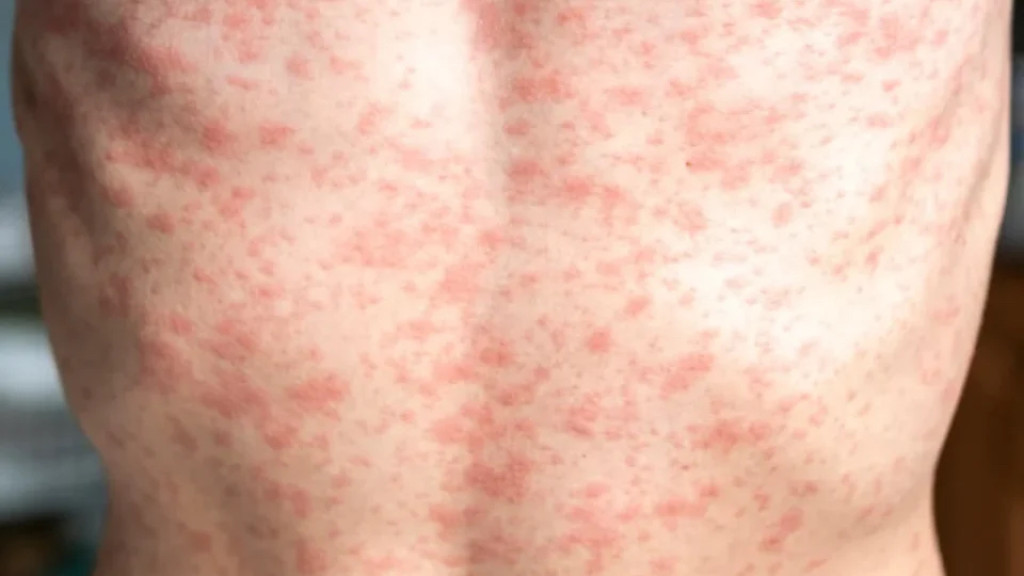 Sarampo - pele manchada de vermelho